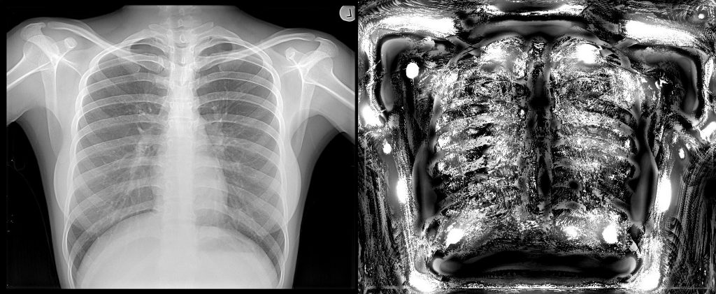 Chest X-ray Deep View Scan (right) using X-ray Sense compared with original X-ray image (left)