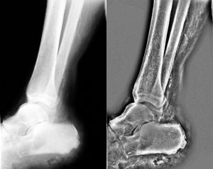 Osteomyelitis chronic-Left Original X-ray scan - Right Miznee scan