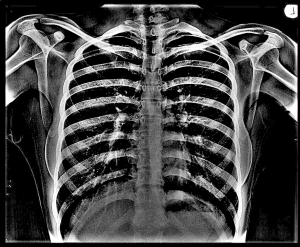 Chest X-ray - Inverted X-ray Sense Scan