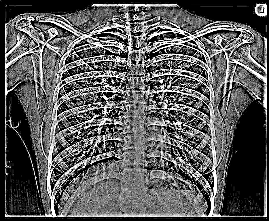 Chest X-ray - X-ray Sense Scan