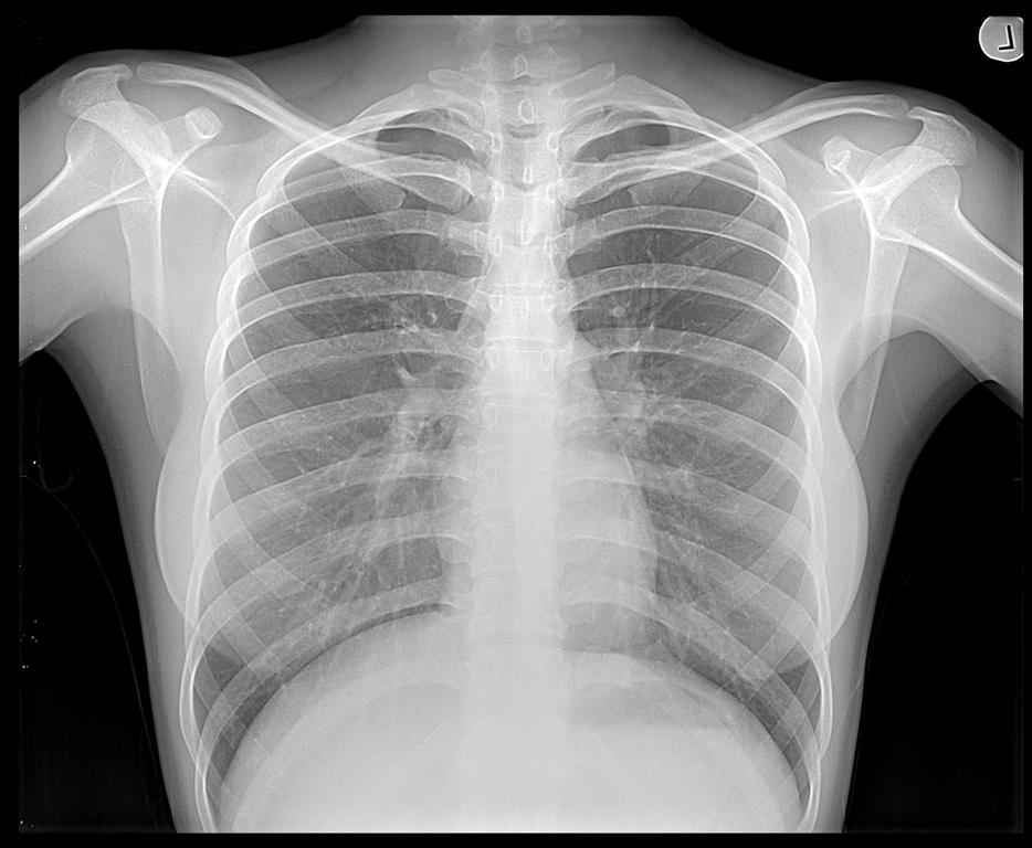Chest X-ray - X-ray - standard