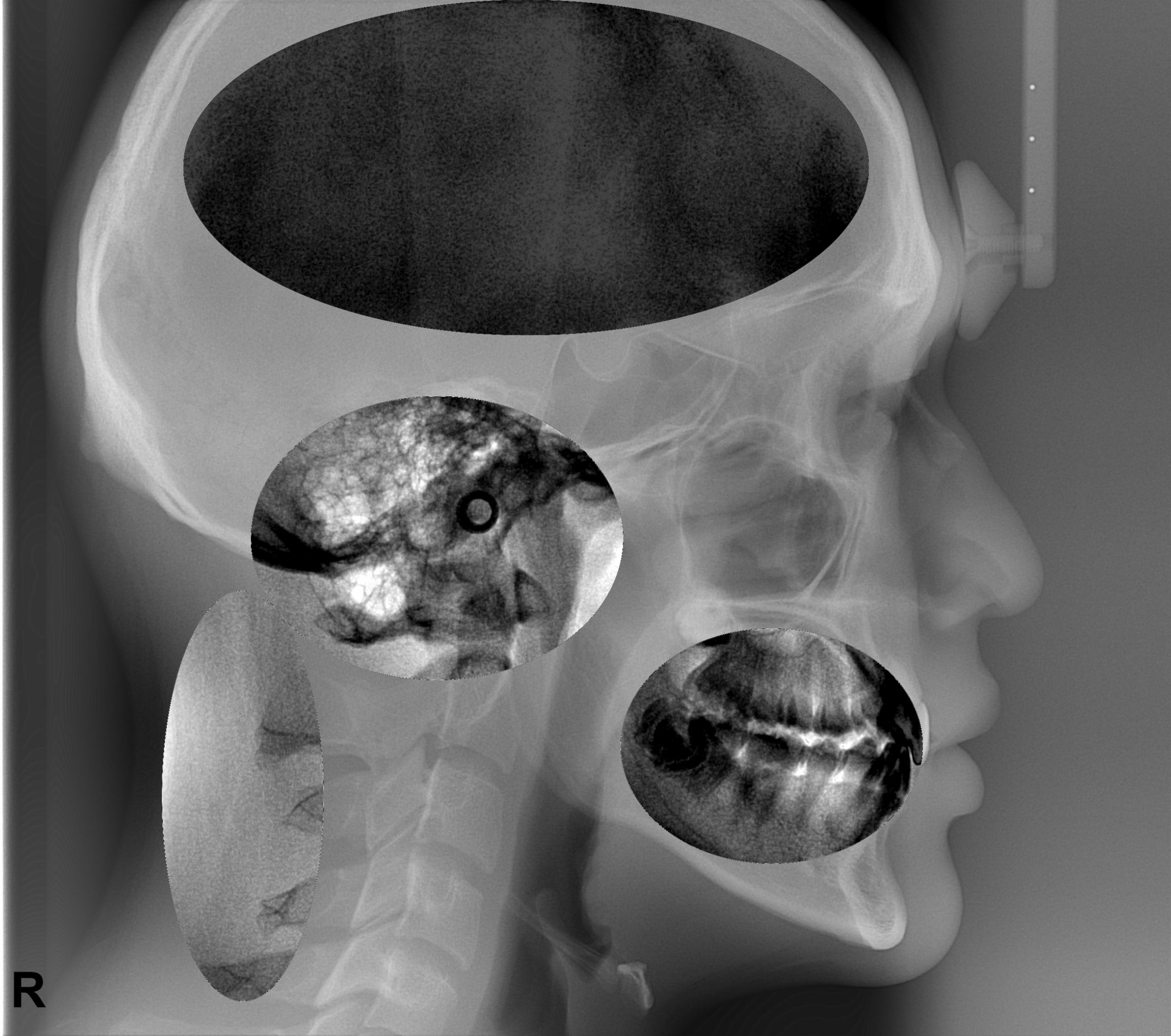 Head X-ray - Inversed X-ray Sense Scan